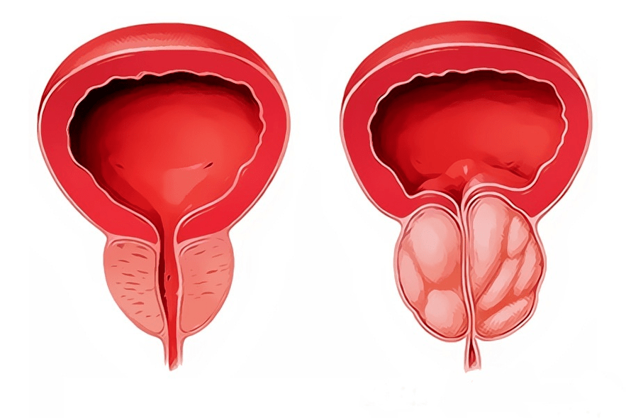 una prostata infiammata e sana