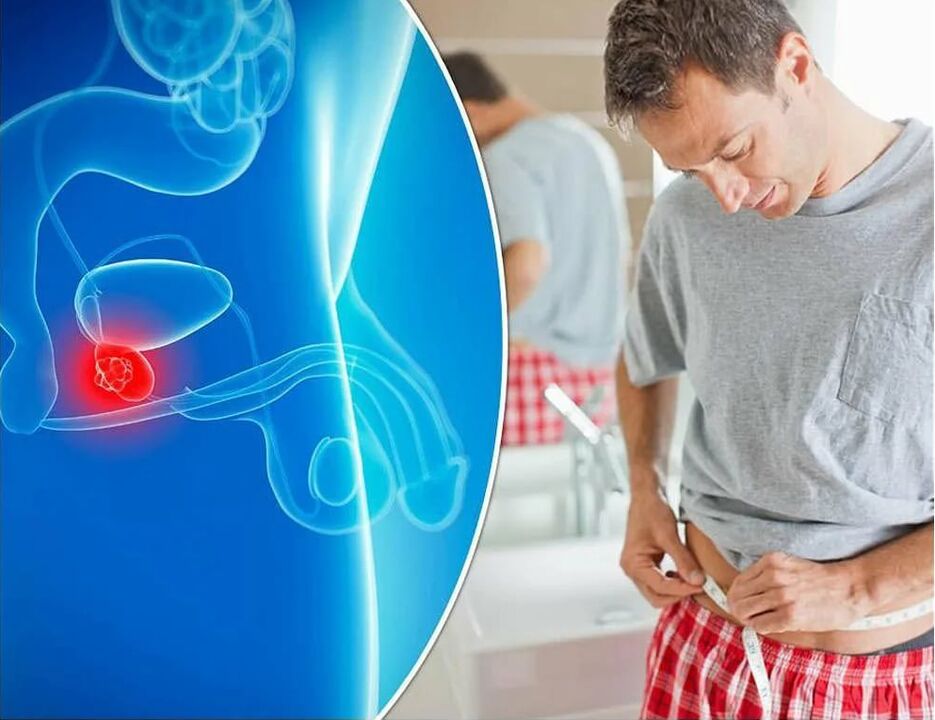 sintomi e cause della prostatite